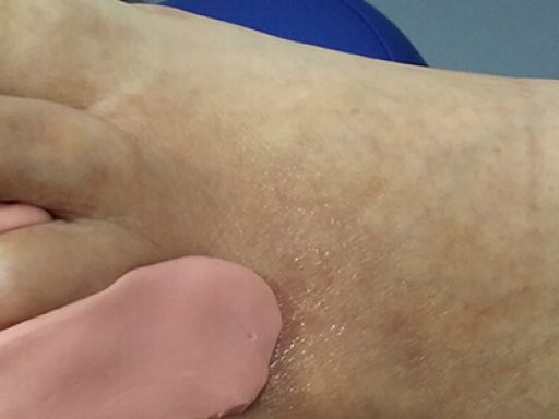 podologia_ortesis_silicona_ivei_vascular_marbella